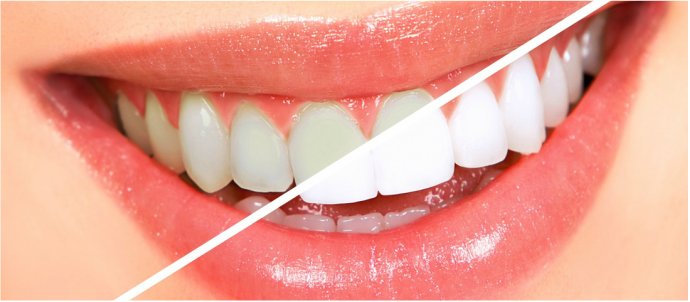 What To Know About Tooth Whitening: